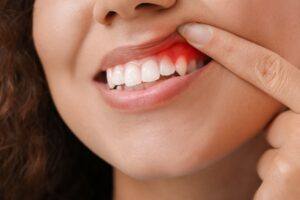 A woman showing her mouth with a red gums, indicating a dental issue or concern.